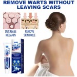 Wart Remover Supplier - Herbal Extract Corn Plaster Treatment Cream