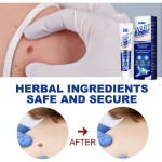 Wart Remover Supplier - Herbal Extract Corn Plaster Treatment Cream