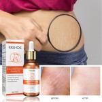 Stretch Mark Cream Manufacturer - Pregnancy Scar Removal Lift Loose
