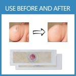 Corns Patch Factory - Barb Foot Pad Dead Skin Health Care