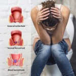 Hemorrhoid Ointment Supplier - Fast Herbal Medicine Postpartum Care