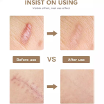 Silicone Scar Tape Manufacturer - Reusable Waterproof Scar Removal Sheet