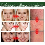 Tea Tree Oil Cream Factory - Organic Acne Pimple Removal