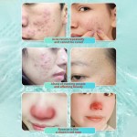 Acne Cream Supplier - Hot Selling Pimple Removal Gel