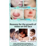 Acne Cream Supplier - Skin Care Precise Removal