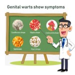 Genital Herpes Cream Manufacturer - Antibacterial Vulva Condyloma