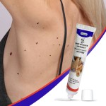 Wart Treatment Supplier - Medical Cream Neck Armpit Removal