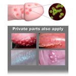 Wart Treatment Supplier - Medical Cream Neck Armpit Removal