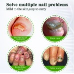 Foot Cream Supplier - Antifungal Infection Repair Gel