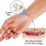 Lice Spray Supplier - 30ml Killing Anti-itch Repellent