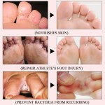Foot Cream Supplier - Antifungal Infection Repair Gel