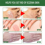 Psoriasis Cream Manufacturer - OEM Anti Itch Dermatitis Relief