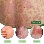 Psoriasis Cream Manufacturer - OEM Anti Itch Dermatitis Relief