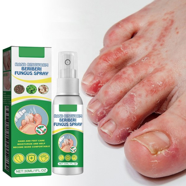 Antifungal Spray Manufacturer - Hand Foot Care Medicine Gentle Formula
