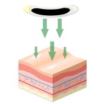Nasal Strip Supplier - Silicone Rubber Breathable Congestion