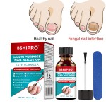 Nail Fungus Kit Manufacturer - Anti-Fungal Brush 30ml Essence