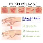 Psoriasis Ointment Supplier - 20g Acne Dermatitis Eczema