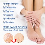 Psoriasis Ointment Supplier - 20g Acne Dermatitis Eczema