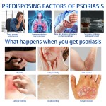 Psoriasis Ointment Supplier - 20g Acne Dermatitis Eczema