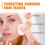 Acne Removal Cream Supplier - Herbal Oil Control BHA Salicylic