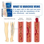 Varicose Vein Cream Factory - New Effective Herbal Ointment Vasculitis Treatment