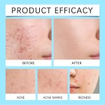 Salicylic Acid Acne Cream Manufacturer - Factory Direct ODM Reduce Blackheads Clear