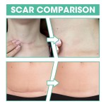 Silicone Scar Sheet Manufacturer - Self-Adhesive Gel Patch Healthcare Scar Removal