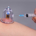 Magnetic Cupping Cups Factory - 6 Size Mix Therapy Massage