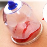 Cupping Sterilizer Supplier - PC Vacuum Therapy Device