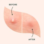 Acne Pimple Patches Manufacturer - Hydrocolloid Invisible Removal Concealer