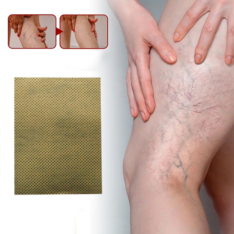 Varicose Veins Patch Supplier - Herbal Supplement Naturally