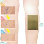 Varicose Veins Patch Supplier - Herbal Supplement Naturally