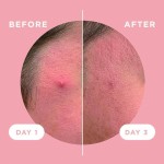 Acne Treatment Patch Supplier - Specialized Healthcare Supply for Acne