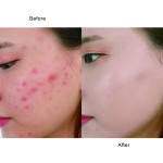 Acne Patch Kit Supplier - Customizable Sizes Refillable Eco-Friendly Reduced