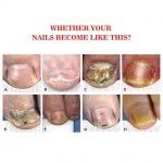 Foot Care Factory - Feet Care Anti Infection Paronychia Treatment