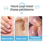 Antifungal Lotion Supplier - Lanthome Nail Fungus Removal Treatment