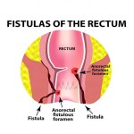 Hemorrhoids Cream Manufacturer - 25g Chinese Herbal HuaTuo Cream