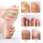 Nail Cream Manufacturer - Lanthome Nail Fungus Removal Cream