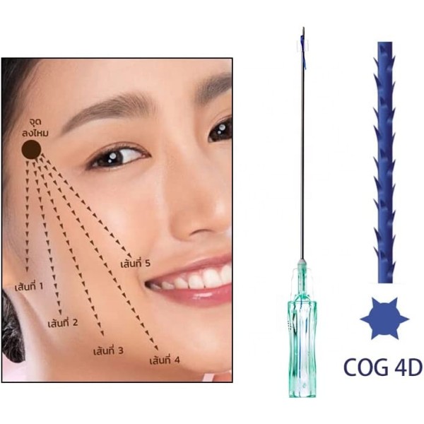 PDO Threads Manufacturer - 4D L Cannula 19G 100MM Facial Threads