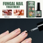 Nail Treatment Supplier - High Quality 15ml Nail Fungus Treatment Nail Health Care