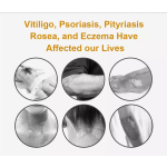 Phototherapy Device Manufacturer - Low Price Vitiligo Phototherapy Treatment Light UVB Lamps