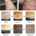 Phototherapy Device Manufacturer - Low Price Vitiligo Phototherapy Treatment Light UVB Lamps