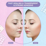 Acne Stickers Manufacturer - Hot Trending Product OEM Acne Stickers Pimple Patch Tea Tree