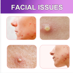 Colorful Acne Patch Manufacturer - 180PCS Colorful Pimple Patch Salicylic Acid Tea Tree Oil