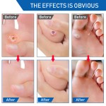 Corn Treatment Pad Manufacturer - Remove Surplus Salicylic Acid Lessen Friction Corn Treatment