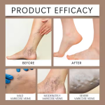 Varicose Veins Gel Factory - Ximonth Horse Chestnut Gel for Varicose Veins Relief Natual