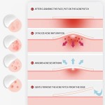 Acne Pimple Patch Factory - Original Hydrocolloid 5g Weight