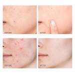 Acne Pimple Patch Factory - Original Hydrocolloid 5g Weight