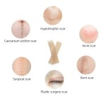 Medical Scar Sheet Factory - OEM/ODM Free Sample Waterproof Dressing