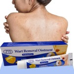 Warts Remover Manufacturer - Blue Ointment Flat Plantar Warts Treatment